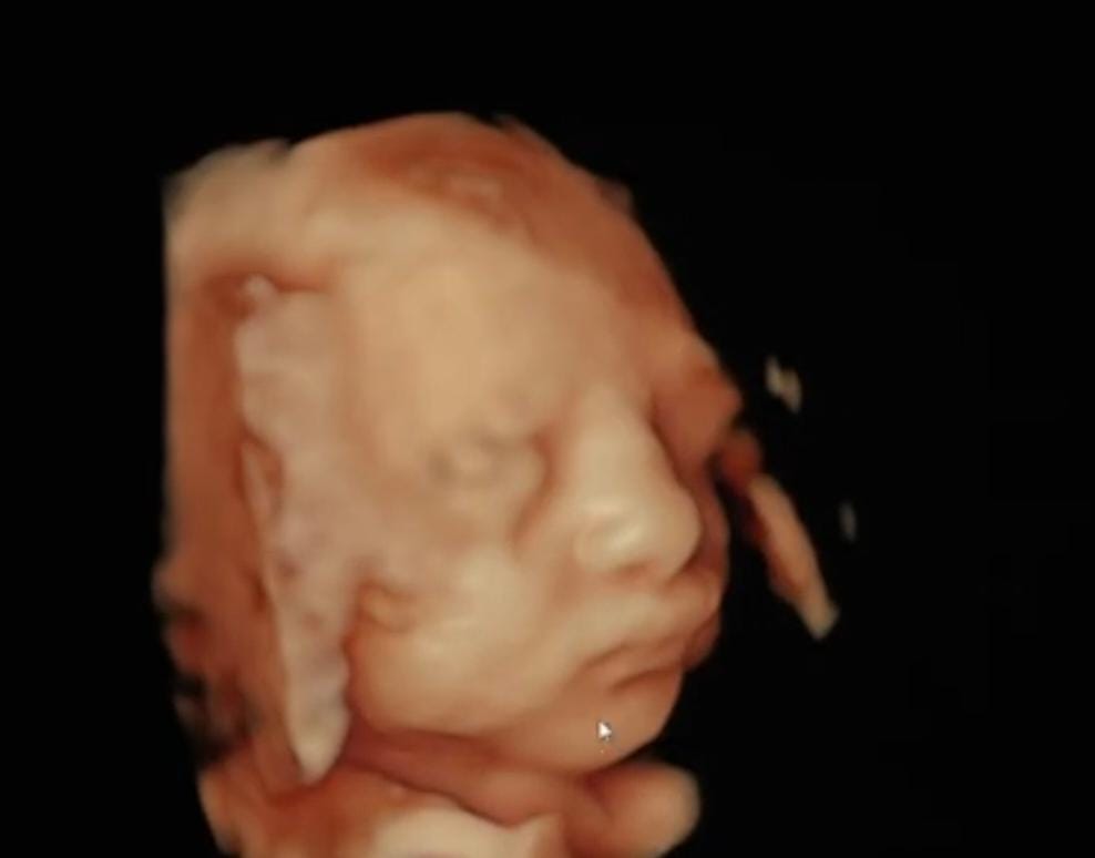 Testimonio Fertilab sas recanalizacion en quindio, armenia, un milagro de vida